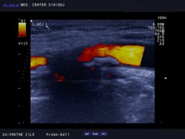 Ultrazvok vratnih žil - ateroskleroza notranje karotidne arterije, vzdolžno